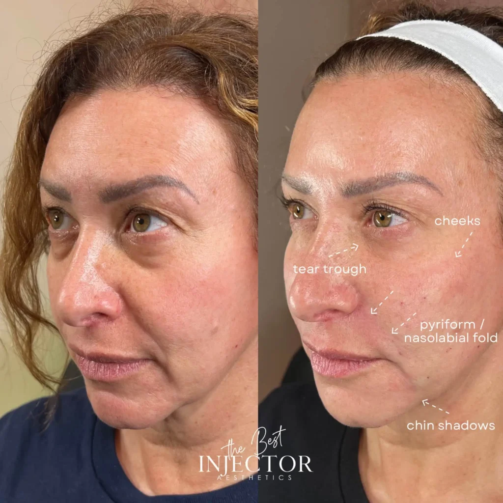 Balance Your Facial Features at The Best Injector