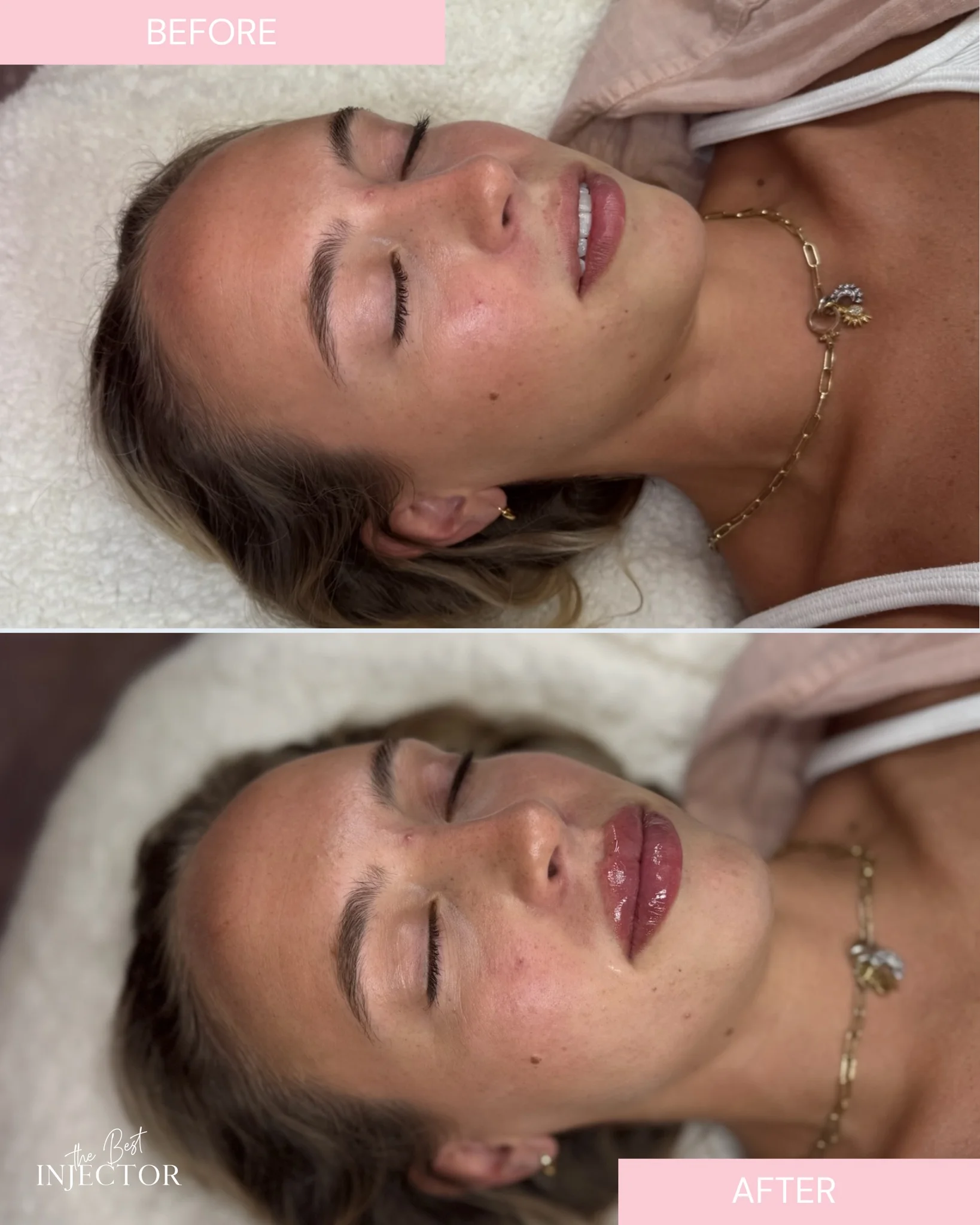 Lip Filler