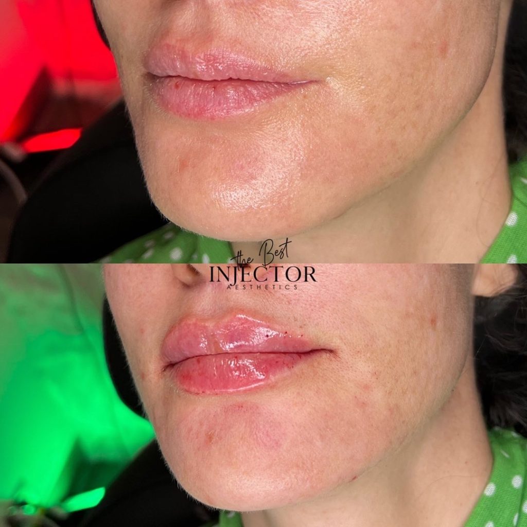 Best Injector – West Atlantic Ave Studio 33 Delray Beach, FL at The Best Injector