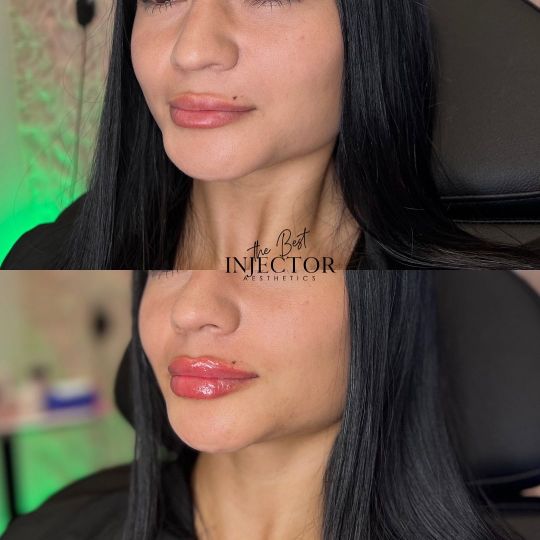 Before And after  | Delray Beach, FL at The Best Injector