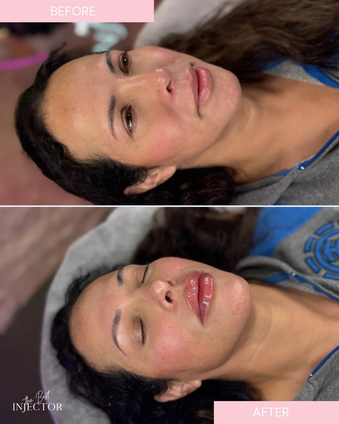 lip filler