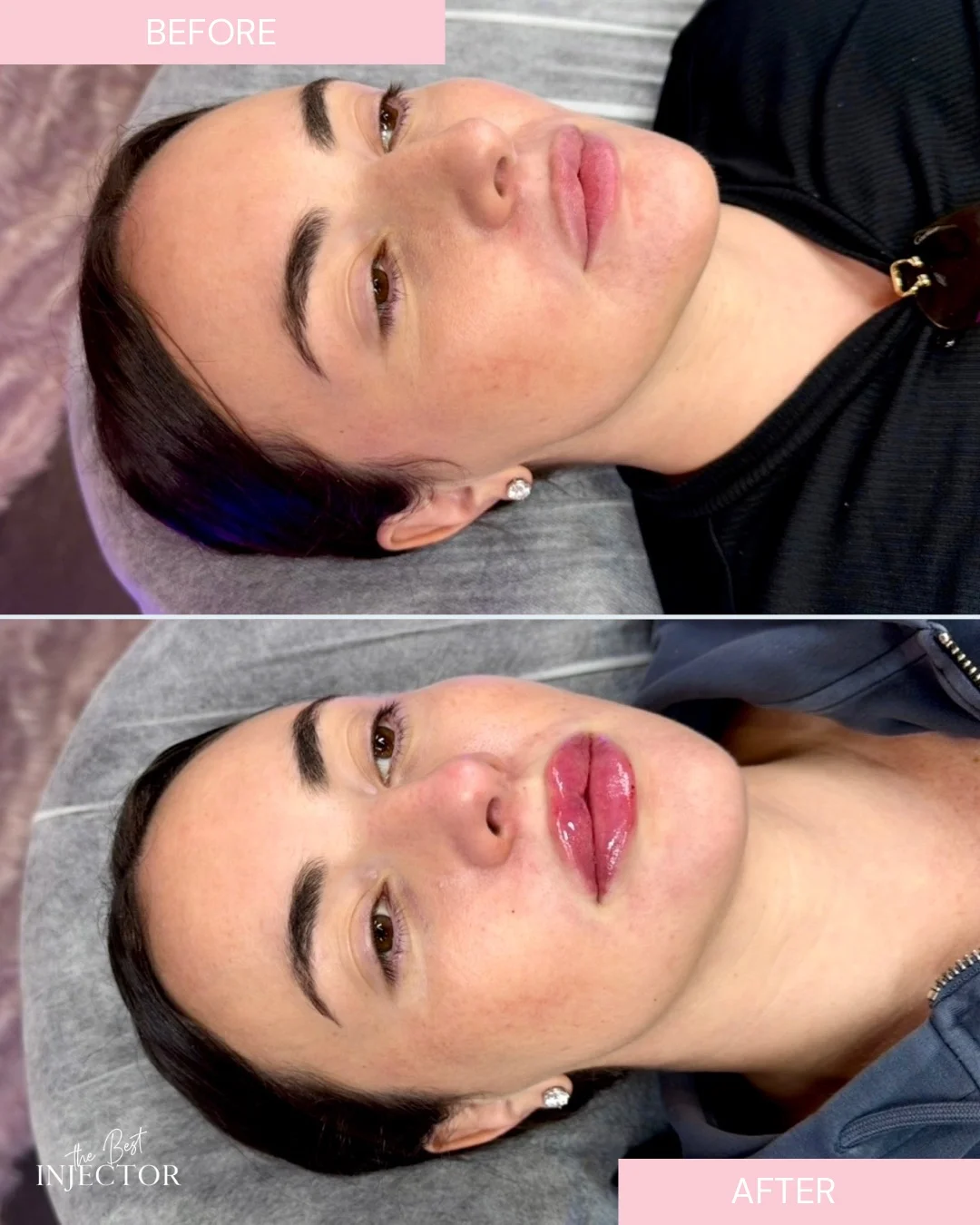 lip filler