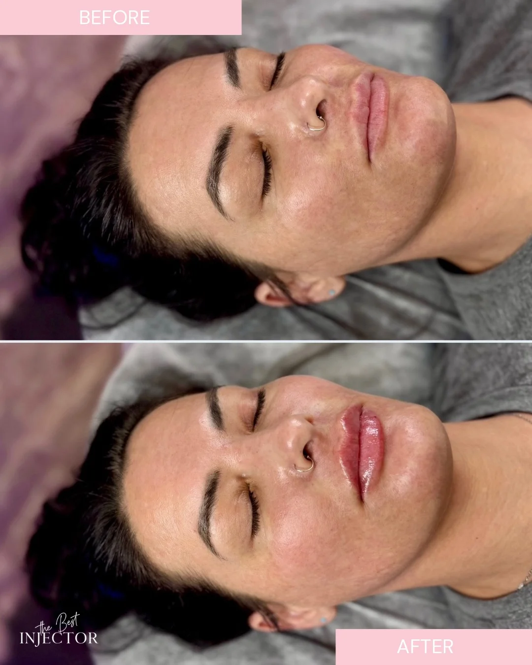 lip filler