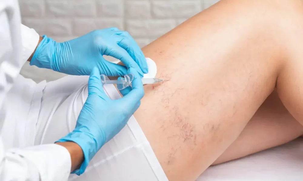 Sclerotherapy by The Best Injector in Delray Beach FL