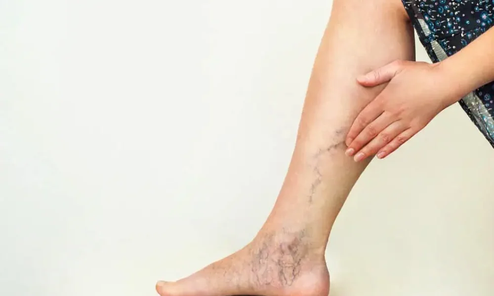 Sclerotherapy for Spider Veins by the Best Injector at Delray Beach FL